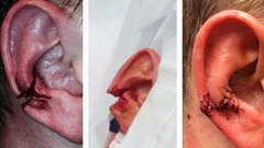 Girgensona komandas biedrs atrāda savu pāršķelto ausi